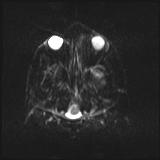 Bilateral basal ganglia and thalamic T1 hyperintensities (Radiopaedia 19764-19802 Axial DWI 2).jpg