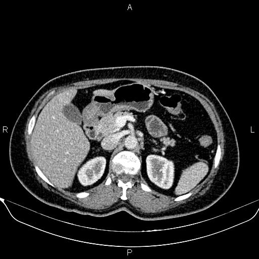 Bilateral benign adrenal adenomas (Radiopaedia 86912-103124 B 37).jpg
