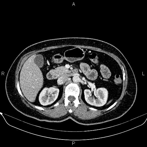 Bilateral benign adrenal adenomas (Radiopaedia 86912-103124 B 41).jpg