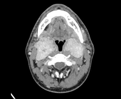 Bilateral carotid body tumors (Radiopaedia 61841-69870 Axial Post contrast 43).jpg