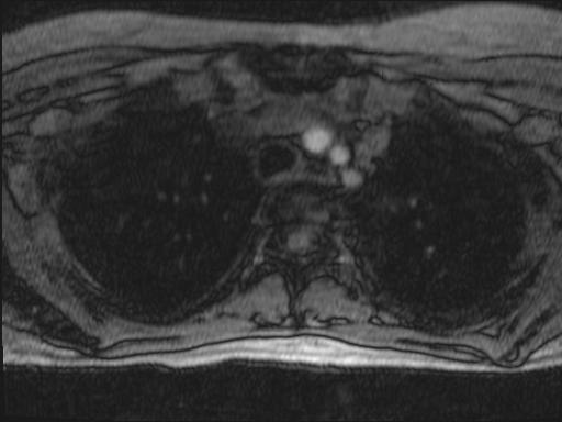 Bilateral carotid body tumors and right glomus jugulare tumor (Radiopaedia 20024-20060 Axial MRA 161).jpg