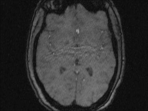 Bilateral carotid body tumors and right glomus jugulare tumor (Radiopaedia 20024-20060 Axial MRA 350).jpg