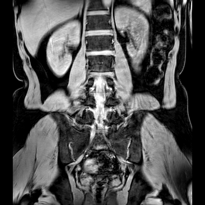Bilateral conjoined nerve roots at different levels (Radiopaedia 73312-84063 Coronal WE 30).jpg