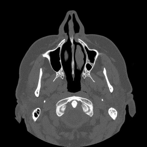 File:Bilateral ectopic infraorbital nerves (Radiopaedia 49006-54084 Axial 13).jpg