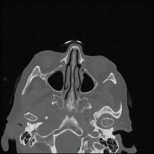 Bilateral frontal mucoceles (Radiopaedia 82352-96454 Axial bone window 174).jpg