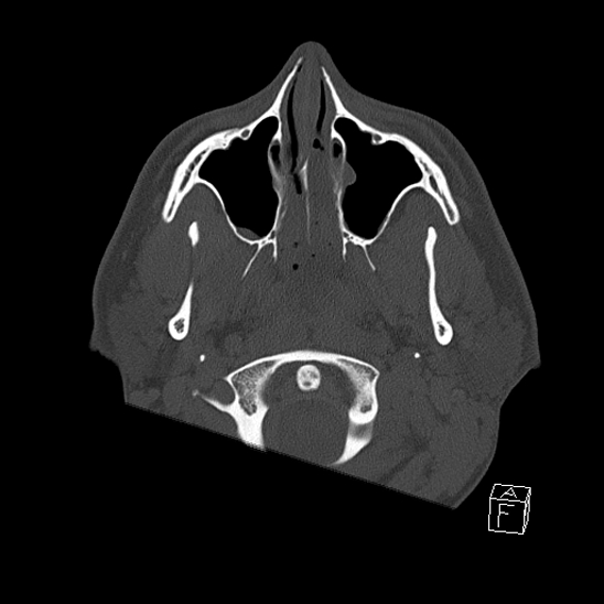 File:Bilateral occipital condyle fracture (type 2) (Radiopaedia 87675-104089 Axial bone window 1).jpg