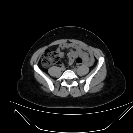 File:Bilateral ovarian mature cystic teratomas (Radiopaedia 79373-92457 Axial non-contrast 39).jpg