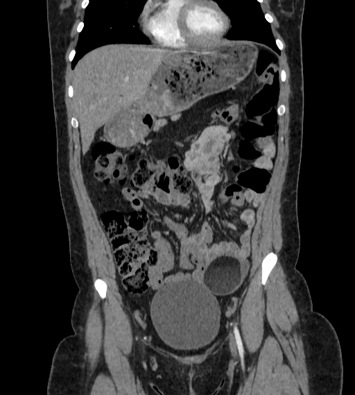 File:Bilateral ovarian mature cystic teratomas (Radiopaedia 79373-92457 B 14).jpg