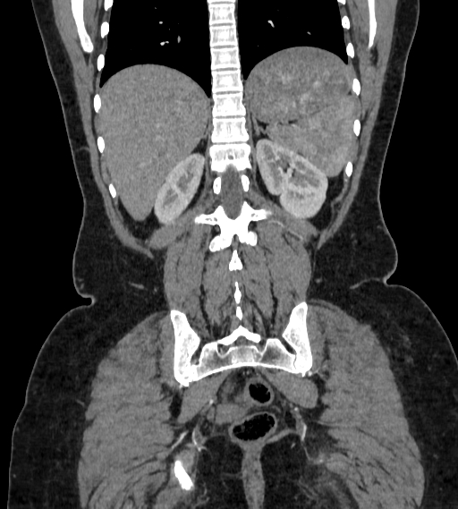 Bilateral ovarian mature cystic teratomas (Radiopaedia 79373-92457 B 77).jpg