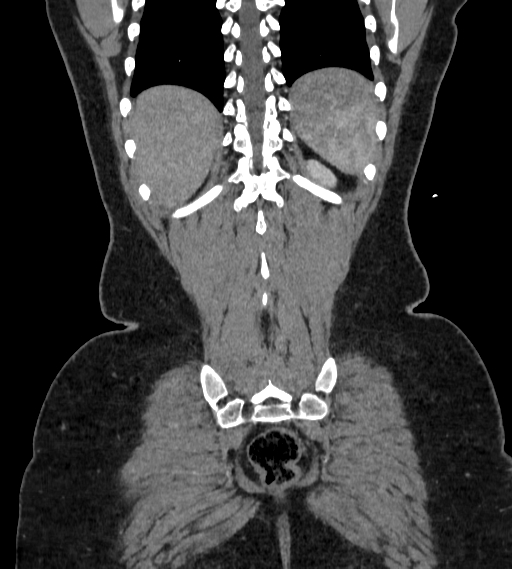Bilateral ovarian mature cystic teratomas (Radiopaedia 79373-92457 B 94).jpg