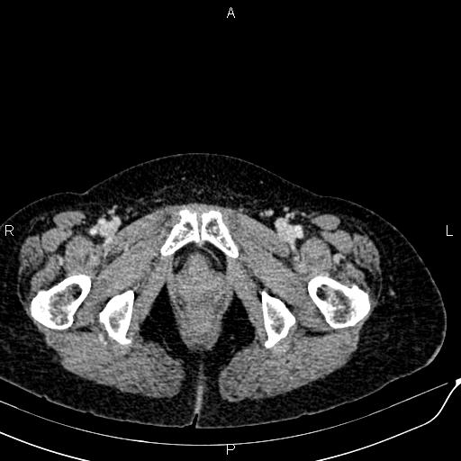 Bilateral ovarian serous cystadenocarcinoma (Radiopaedia 86062-101989 B 104).jpg