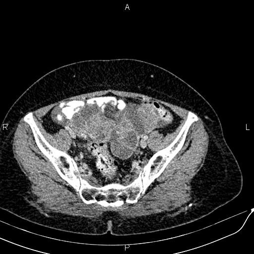 Bilateral ovarian serous cystadenocarcinoma (Radiopaedia 86062-101989 B 83).jpg