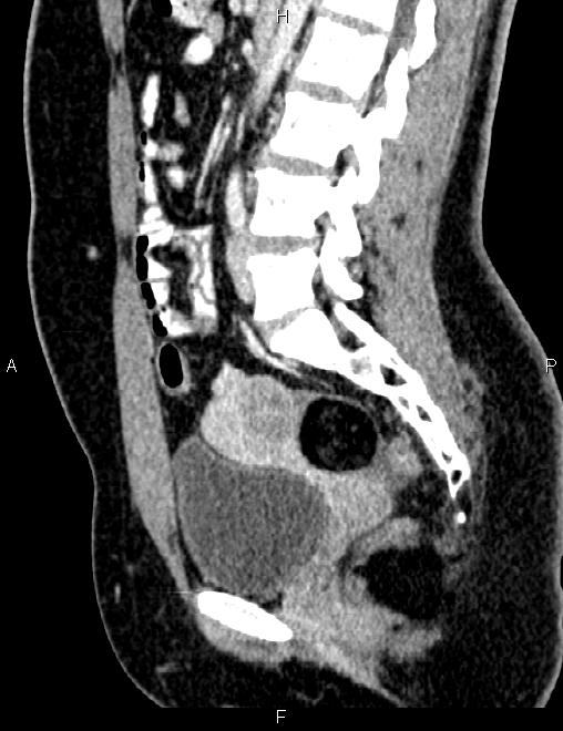Bilateral ovarian teratoma (Radiopaedia 83131-97503 D 66).jpg