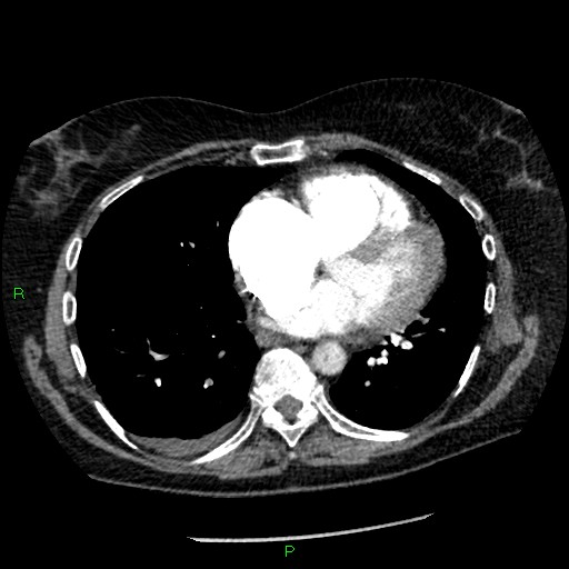 Bilateral pulmonary emboli (Radiopaedia 32700-33669 Axial C+ CTPA 70).jpg