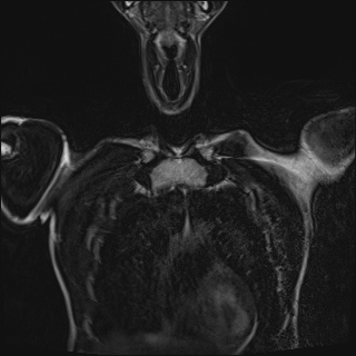 Bilateral spinoglenoid notch ganglion cysts (Radiopaedia 29577-30082 Coronal T2 19).jpg
