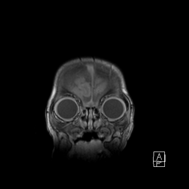 Bilateral subdural hemorrhage and parietal skull fracture (Radiopaedia 26058-26190 Coronal T1 4).png