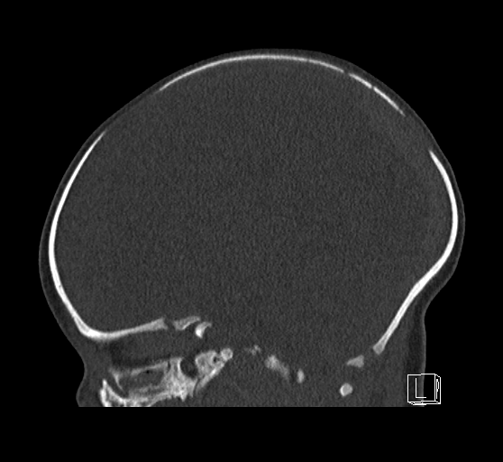 File:Bilateral subdural hemorrhage and parietal skull fracture (Radiopaedia 26058-26192 Sagittal bone window 41).png