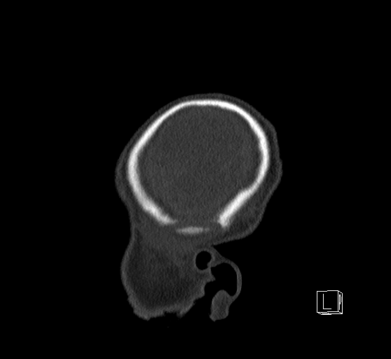 Bilateral subdural hemorrhage and parietal skull fracture (Radiopaedia 26058-26192 Sagittal bone window 6).png