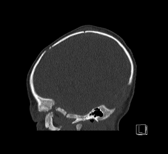 Bilateral subdural hemorrhage and parietal skull fracture (Radiopaedia 26058-26192 Sagittal bone window 80).png