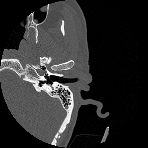 File:Bilateral temporal bone fractures (Radiopaedia 29482-29970 D 55).jpg