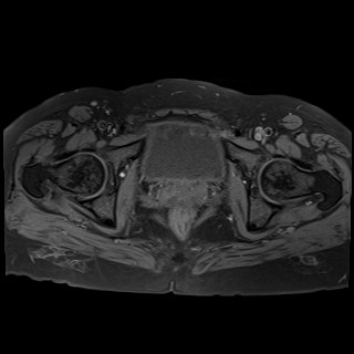 Bilateral tubo-ovarian abscesses (Radiopaedia 58635-65829 Axial T1 fat sat 36).jpg