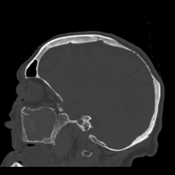 Biparietal osteodystrophy (Radiopaedia 46109-50463 Sagittal bone window 72).jpg