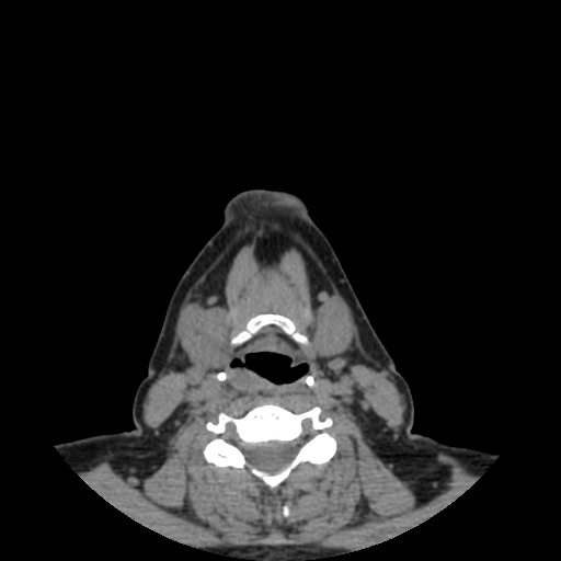 File:Bisphosphonate-related osteonecrosis of the jaw (Radiopaedia 71324-81642 non-contrast 3).jpg