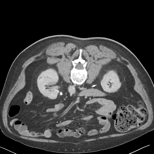 File:Bladder papillary urothelial carcinoma (Radiopaedia 48119-52951 Axial C+ delayed 23).png