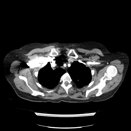 File:Bladder tumor detected on trauma CT (Radiopaedia 51809-57609 A 19).jpg