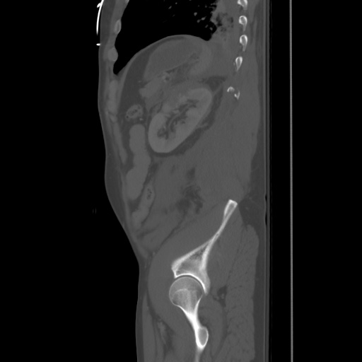 Blunt abdominal trauma with solid organ and musculoskelatal injury with active extravasation (Radiopaedia 68364-77895 Sagittal bone window 85).jpg