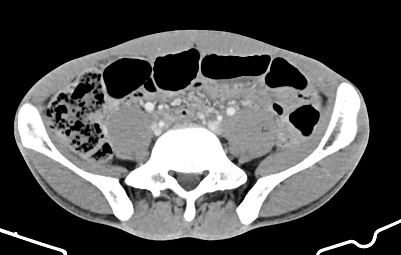 Blunt injury to the small bowel (Radiopaedia 74953-85987 A 132).jpg