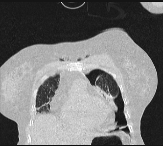 Boerhaave syndrome (Radiopaedia 45644-49799 Coronal lung window 15).jpg