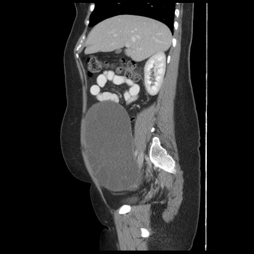 File:Borderline mucinous tumor (ovary) (Radiopaedia 78228-90808 B 25).jpg