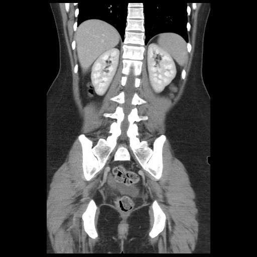 Borderline mucinous tumor (ovary) (Radiopaedia 78228-90808 C 37).jpg