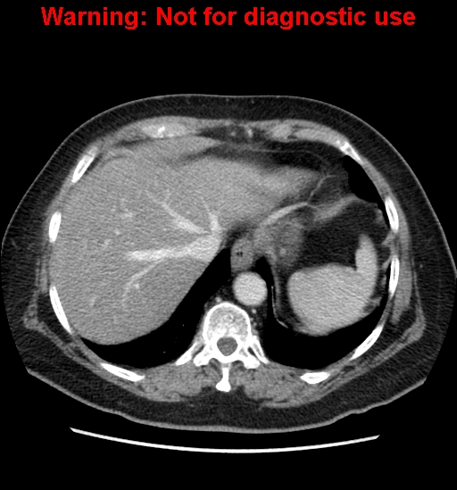 File:Bosniak renal cyst - type II (Radiopaedia 23404-23468 D 12).jpg