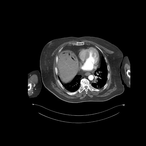 File:Bowel ischemia secondary to SMA occlusion with extensive portomesenteric venous gas (Radiopaedia 54656-60871 A 73).jpg
