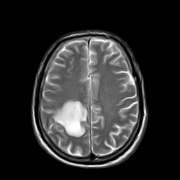 File:Brain abscess complicated by intraventricular rupture and ventriculitis (Radiopaedia 82434-96571 Axial T2 18).jpg