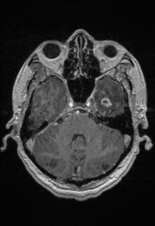 Brain abscess with ventriculitis (Radiopaedia 85703-101495 Axial T1 C+ 53).jpg