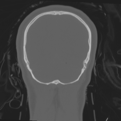 Brain contusions, internal carotid artery dissection and base of skull fracture (Radiopaedia 34089-35339 Coronal bone window 58).png