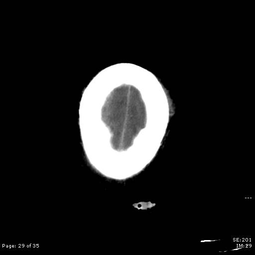 File:Brain death after motor vehicle collision (Radiopaedia 88470-105114 Axial non-contrast 29).jpg