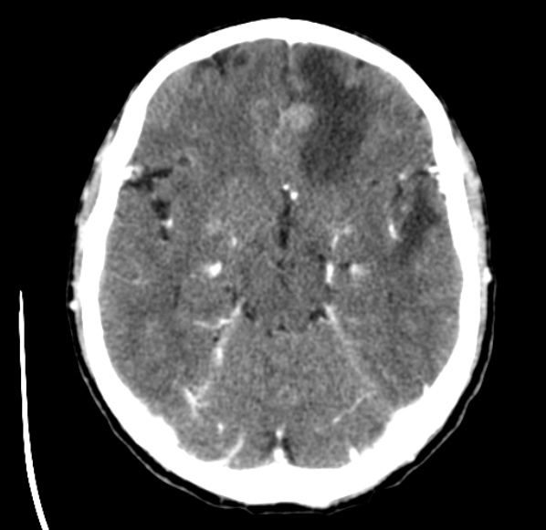 File:Brain metastases from lung cancer (Radiopaedia 24480-24781 Axial C+ delayed 22).jpg