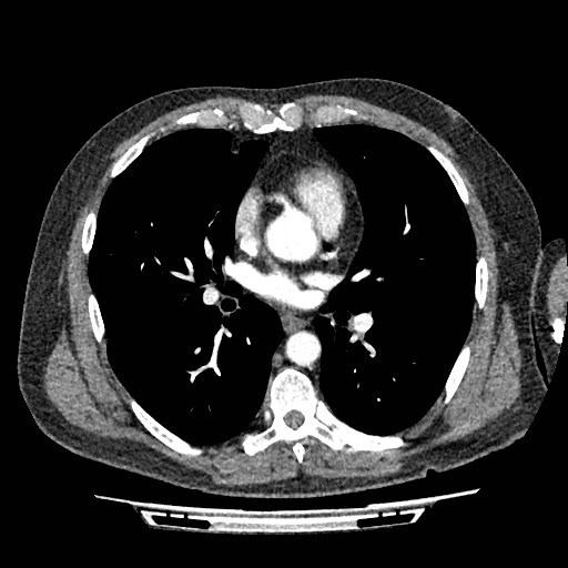 File:Brain metastases from lung cancer (Radiopaedia 83839-99030 B 52).jpg