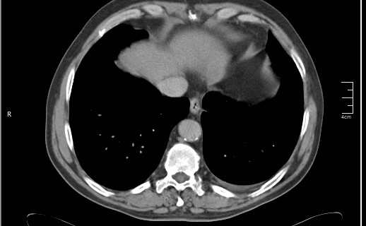 File:Brain metastases from squamocellular lung cancer (Radiopaedia 56515-63219 B 50).jpg