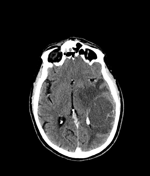 Brain metastasis (large cystic mass) (Radiopaedia 47497-52106 Axial C+ 32).png