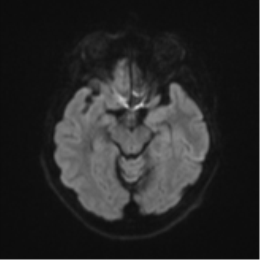 Brain metastasis (sarcoma) (Radiopaedia 47576-52209 Axial DWI 39).png