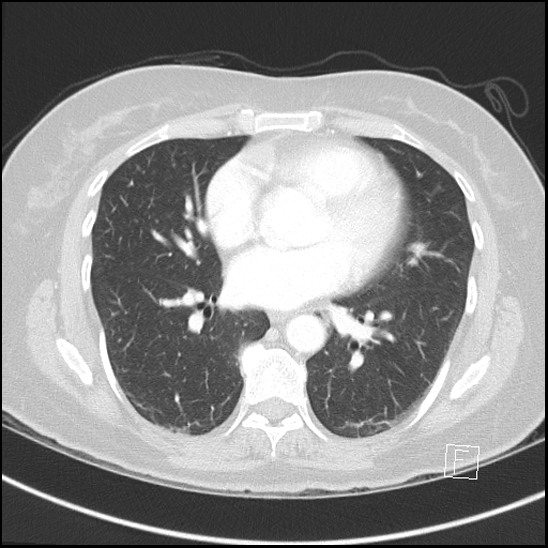 Breast metastases from renal cell cancer (Radiopaedia 79220-92225 Axial lung window 50).jpg