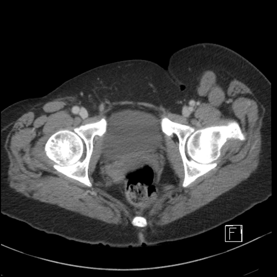File:Breast metastases from renal cell cancer (Radiopaedia 79220-92225 C 117).jpg