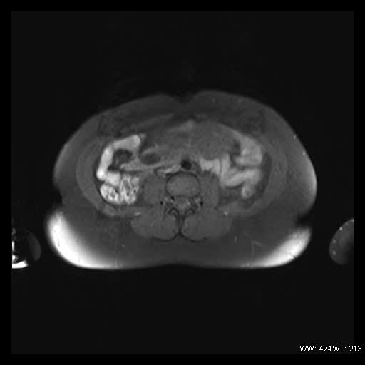 File:Broad ligament fibroid (Radiopaedia 49135-54241 Axial T1 fat sat 1).jpg