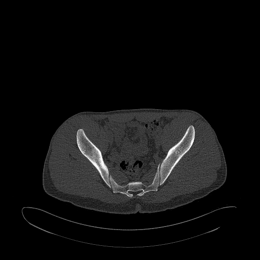 Brodie abscess- femoral neck (Radiopaedia 53862-59966 Axial bone window 87).jpg