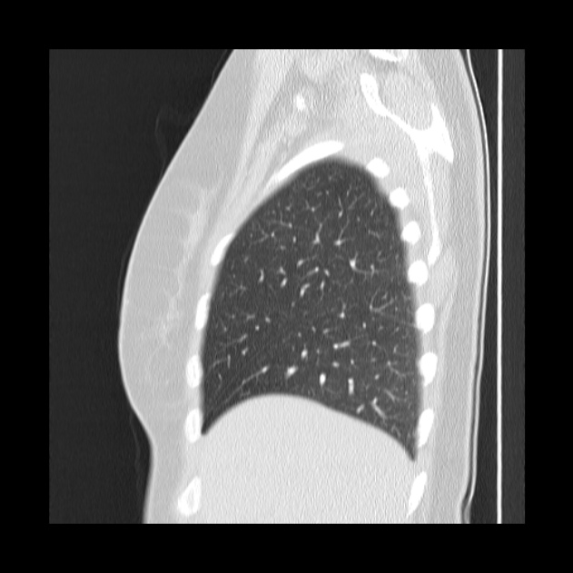 Bronchial atresia (Radiopaedia 22965-22992 Sagittal lung window 46).jpg